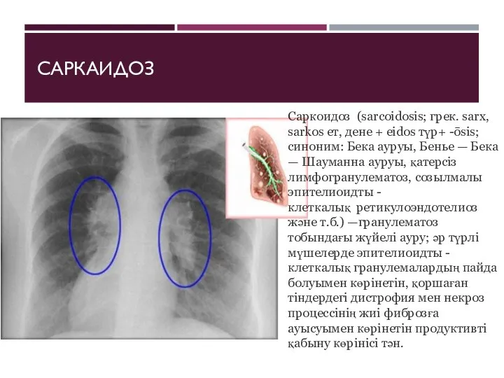 САРКАИДОЗ Саркоидоз (sarcoidosis; грек. sarx, sarkos ет, дене + eidos түр+ -ōsis;