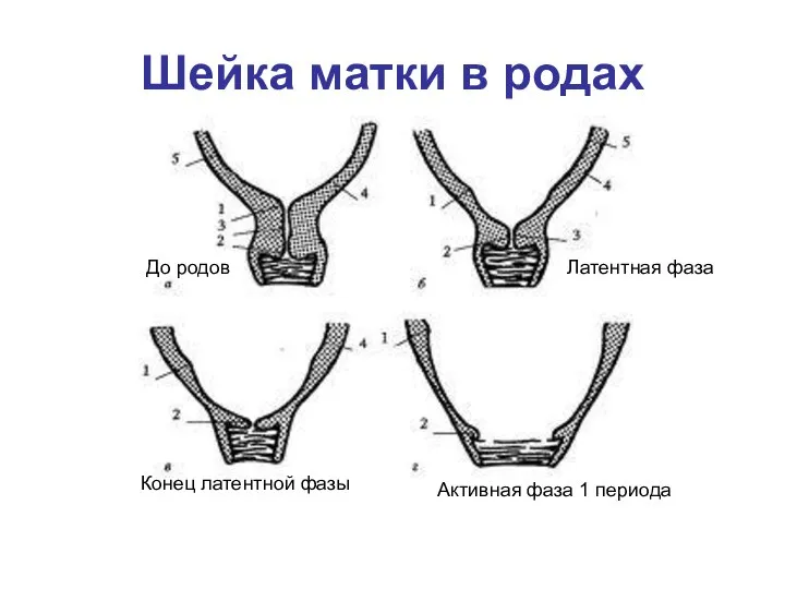 Шейка матки в родах Конец латентной фазы До родов Латентная фаза Активная фаза 1 периода