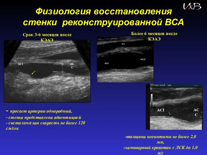 Физиология восстановления стенки реконструированной ВСА - просвет артерии однородный, - стенка представлена