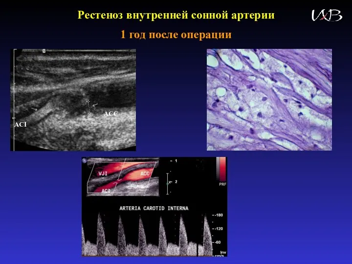 Рестеноз внутренней сонной артерии 1 год после операции ACC ACI