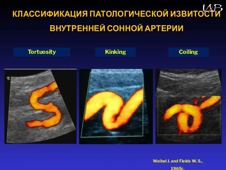 КЛАССИФИКАЦИЯ ПАТОЛОГИЧЕСКОЙ ИЗВИТОСТИ ВНУТРЕННЕЙ СОННОЙ АРТЕРИИ Tortuosity Kinking Coiling Weibel J. and Fields W. S., 1965г.