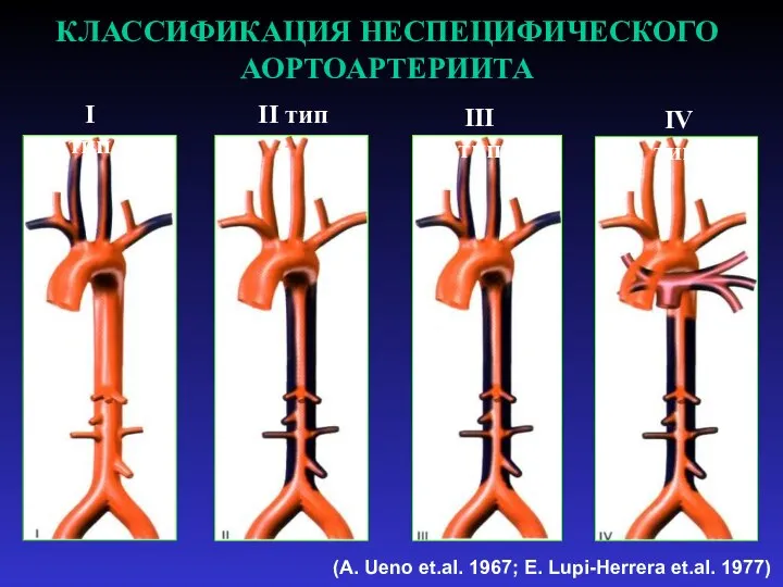 (A. Ueno et.al. 1967; E. Lupi-Herrera et.al. 1977) КЛАССИФИКАЦИЯ НЕСПЕЦИФИЧЕСКОГО АОРТОАРТЕРИИТА I