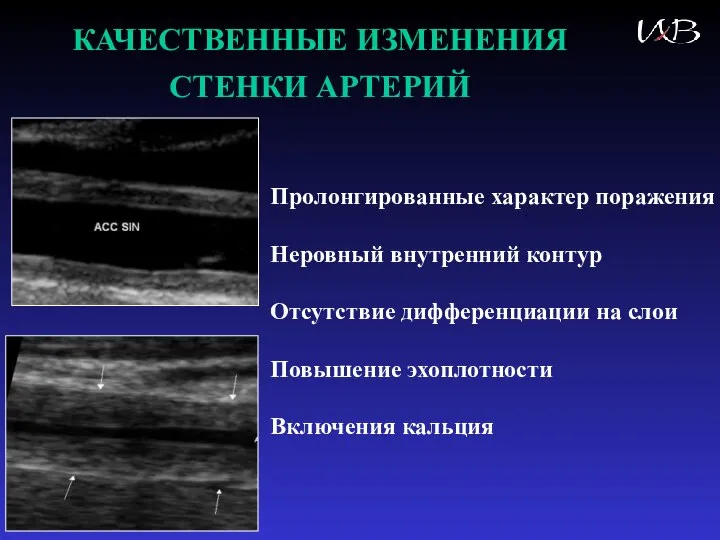 КАЧЕСТВЕННЫЕ ИЗМЕНЕНИЯ СТЕНКИ АРТЕРИЙ Пролонгированные характер поражения Неровный внутренний контур Отсутствие дифференциации