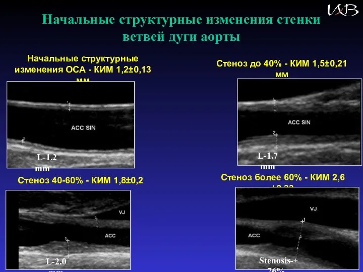 Начальные структурные изменения стенки ветвей дуги аорты Начальные структурные изменения ОСА -