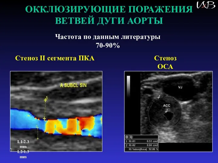 ОККЛЮЗИРУЮЩИЕ ПОРАЖЕНИЯ ВЕТВЕЙ ДУГИ АОРТЫ Частота по данным литературы 70-90% L1-2.3 mm