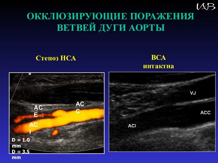 ОККЛЮЗИРУЮЩИЕ ПОРАЖЕНИЯ ВЕТВЕЙ ДУГИ АОРТЫ D = 1.0 mm D = 3.5