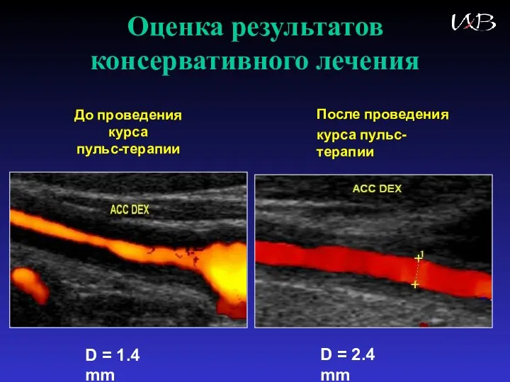 Оценка результатов консервативного лечения D = 1.4 mm До проведения курса пульс-терапии