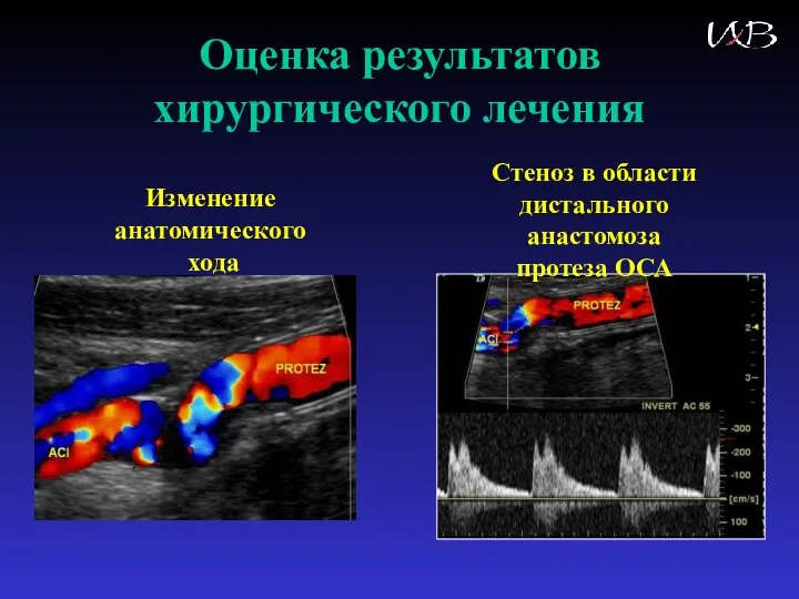 Оценка результатов хирургического лечения Изменение анатомического хода Стеноз в области дистального анастомоза протеза ОСА