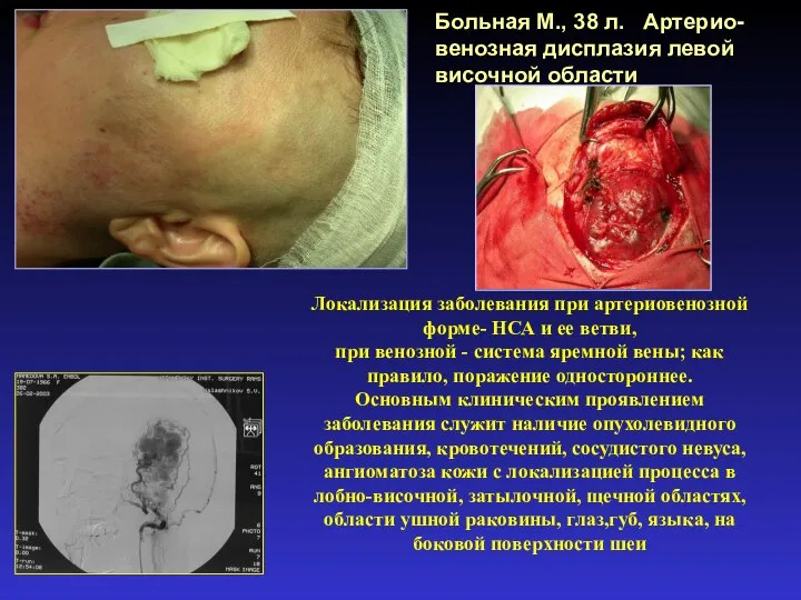 Больная М., 38 л. Артерио-венозная дисплазия левой височной области Локализация заболевания при