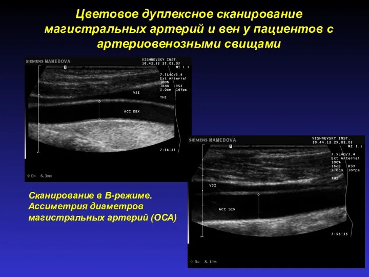 Сканирование в В-режиме. Ассиметрия диаметров магистральных артерий (ОСА) Цветовое дуплексное сканирование магистральных