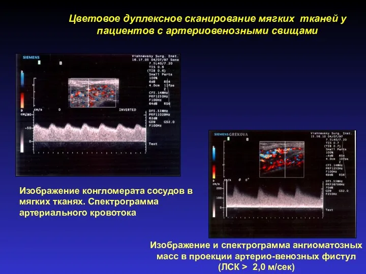 Изображение и спектрограмма ангиоматозных масс в проекции артерио-венозных фистул (ЛСК > 2,0