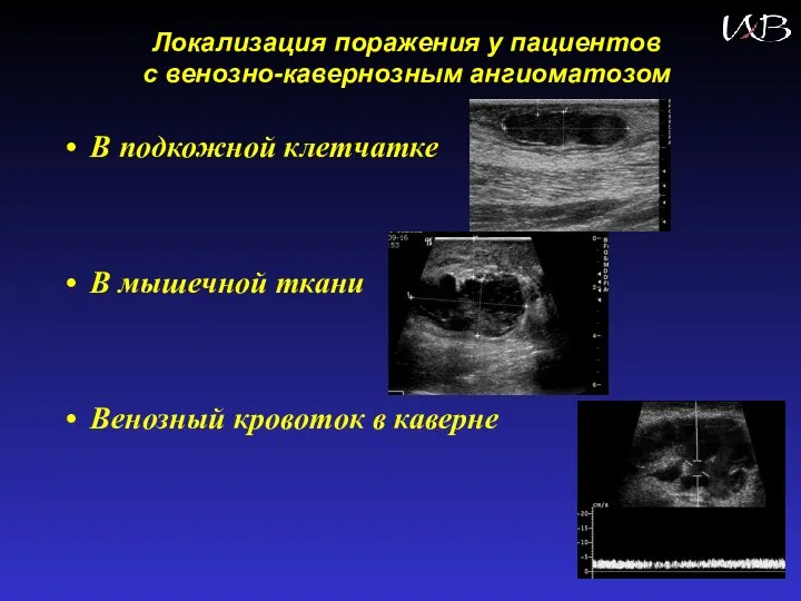 Локализация поражения у пациентов с венозно-кавернозным ангиоматозом В подкожной клетчатке В мышечной