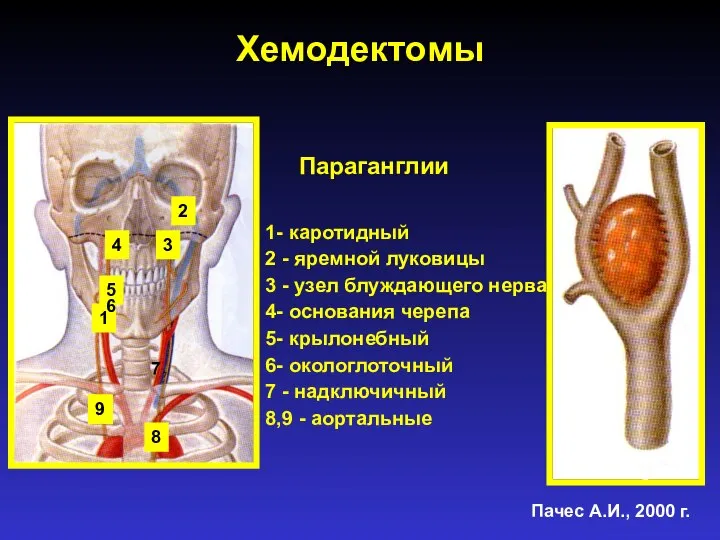 Хемодектомы Параганглии 1- каротидный 2 - яремной луковицы 3 - узел блуждающего