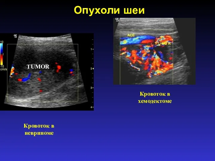 Опухоли шеи Кровоток в невриноме Кровоток в хемодектоме TUMOR