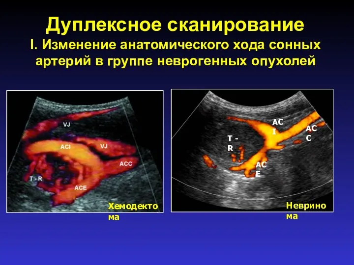 Дуплексное сканирование I. Изменение анатомического хода сонных артерий в группе неврогенных опухолей