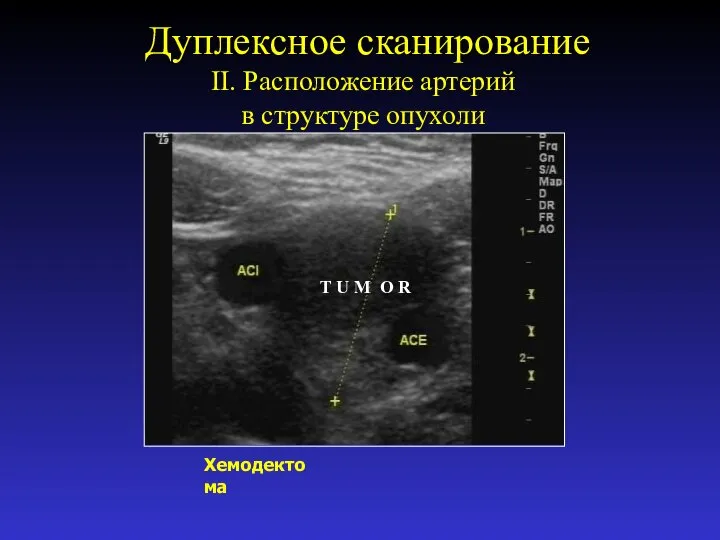 Дуплексное сканирование II. Расположение артерий в структуре опухоли Хемодектома T U M O R