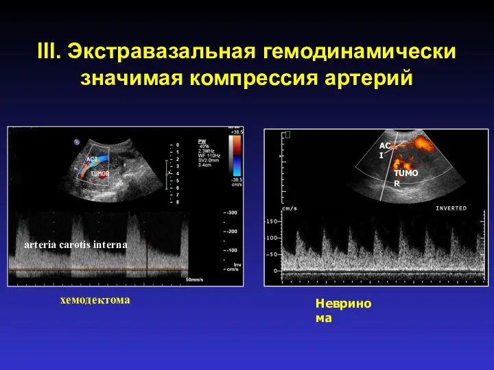 III. Экстравазальная гемодинамически значимая компрессия артерий TUMOR ACI Невринома arteria carotis interna хемодектома