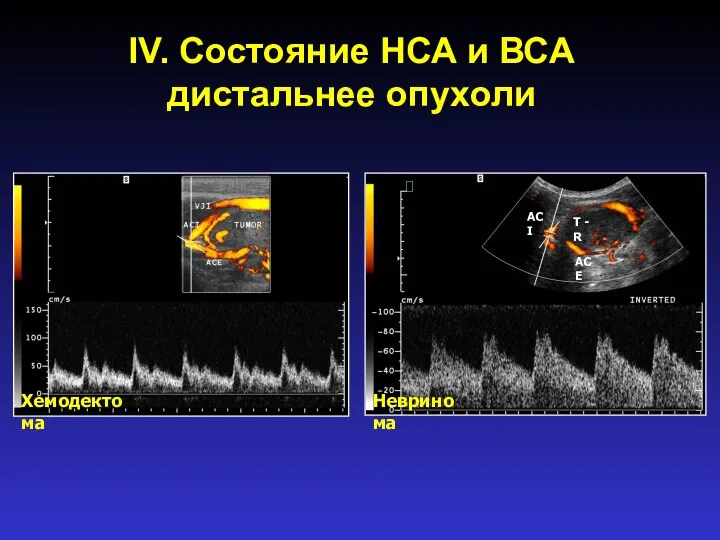 IV. Состояние НСА и ВСА дистальнее опухоли ACI ACE T - R Хемодектома Невринома