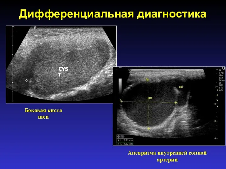 Дифференциальная диагностика CYST Боковая киста шеи Аневризма внутренней сонной артерии