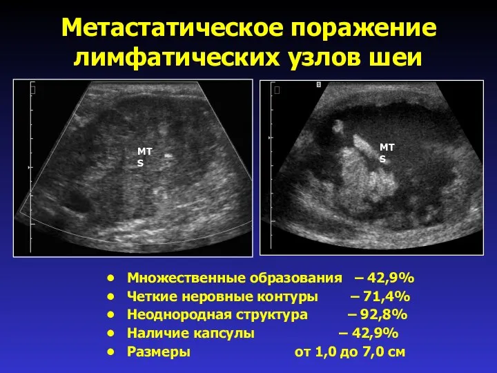 Метастатическое поражение лимфатических узлов шеи Множественные образования – 42,9% Четкие неровные контуры