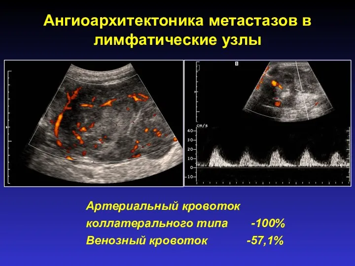 Ангиоархитектоника метастазов в лимфатические узлы Артериальный кровоток коллатерального типа -100% Венозный кровоток -57,1%