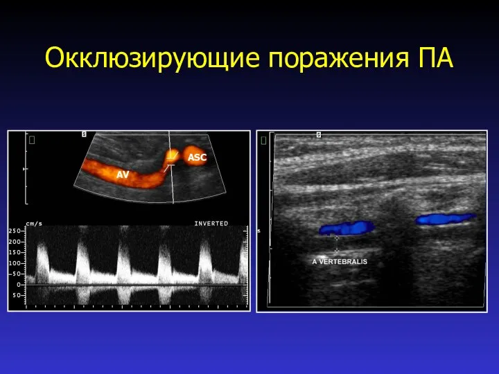 Окклюзирующие поражения ПА ASC AV