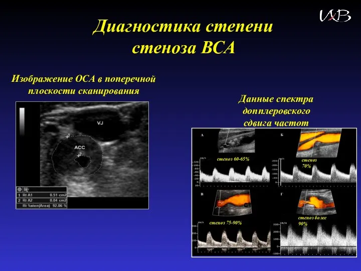 Диагностика степени стеноза ВСА стеноз >90% стеноз 60-65% стеноз 70% стеноз 75-90%