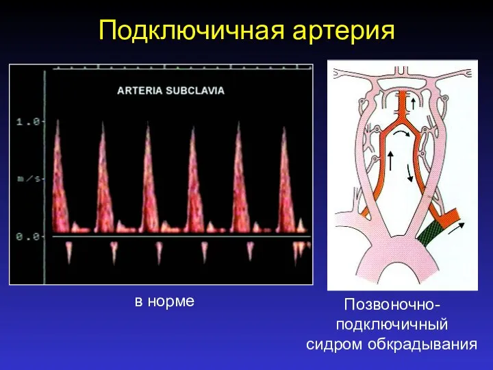 Подключичная артерия в норме Позвоночно- подключичный сидром обкрадывания