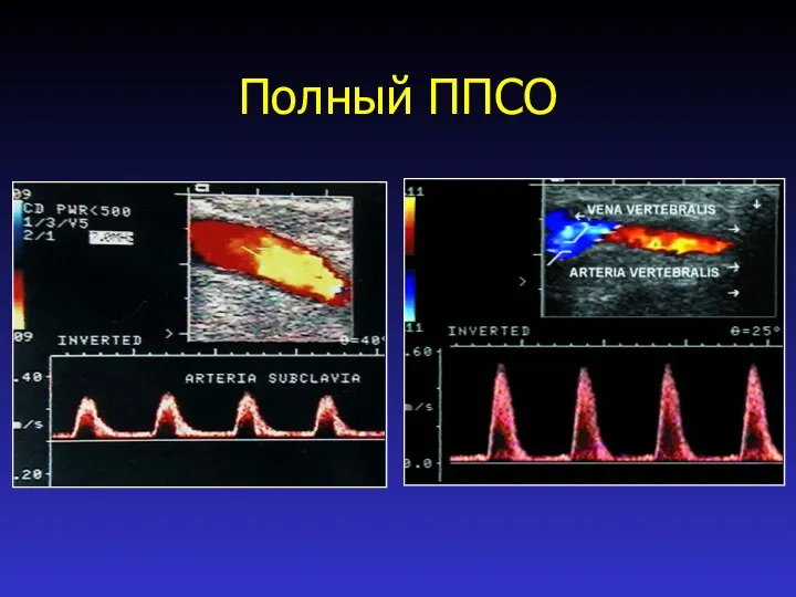 Полный ППСО