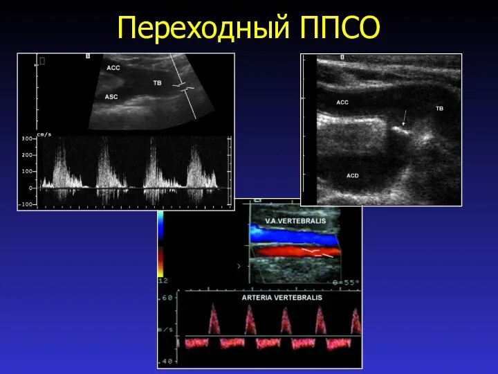 Переходный ППСО