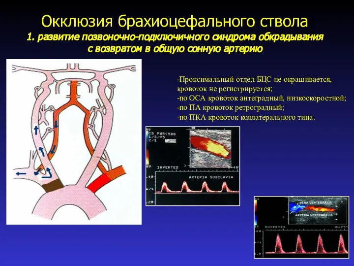 Окклюзия брахиоцефального ствола 1. развитие позвоночно-подключичного синдрома обкрадывания с возвратом в общую