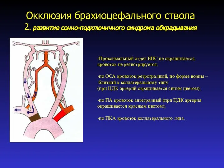 Окклюзия брахиоцефального ствола 2. развитие сонно-подключичного синдрома обкрадывания -Проксимальный отдел БЦС не