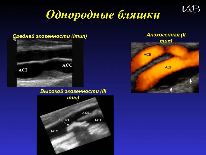 Однородные бляшки Анэхогенная (II тип) Средней эхогенности (Iтип) Высокой эхогенности (III тип) ACI ACC