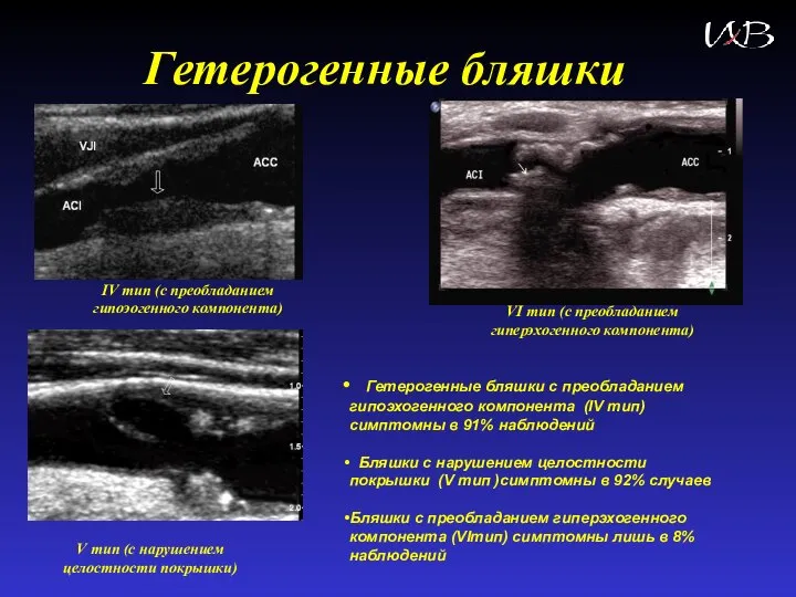 Гетерогенные бляшки Гетерогенные бляшки с преобладанием гипоэхогенного компонента (IV тип) симптомны в