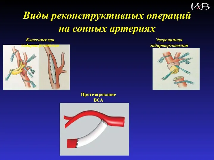 Виды реконструктивных операций на сонных артериях Классическая эндартерэктомия Эверсионная эндартерэктомия Протезирование ВСА