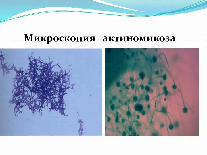 Микроскопия актиномикоза