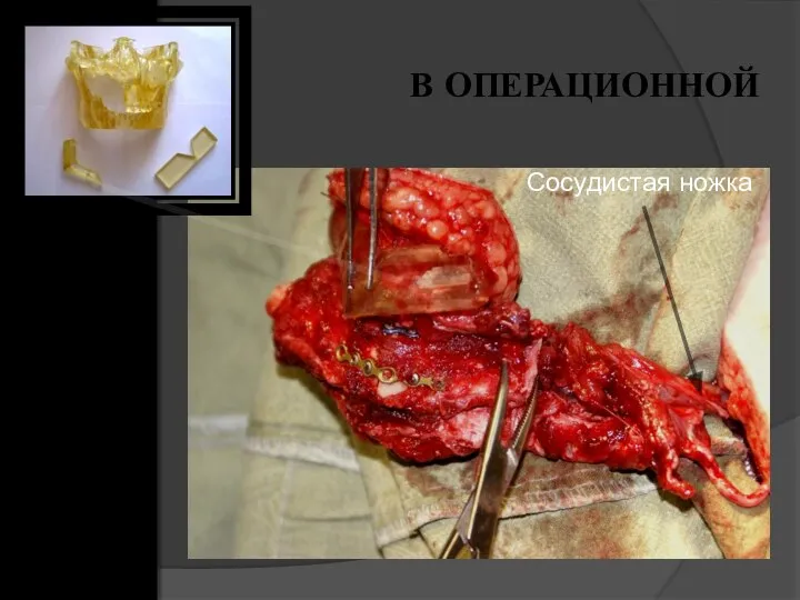 В ОПЕРАЦИОННОЙ Сосудистая ножка