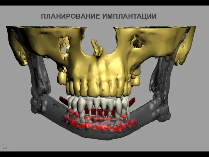 ПЛАНИРОВАНИЕ ИМПЛАНТАЦИИ