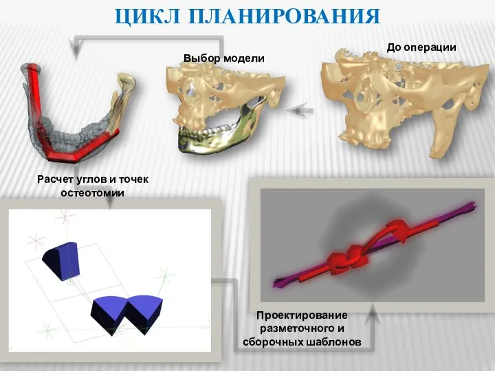 ЦИКЛ ПЛАНИРОВАНИЯ До операции Выбор модели Расчет углов и точек остеотомии Проектирование разметочного и сборочных шаблонов