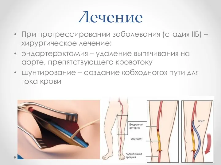 Лечение При прогрессировании заболевания (стадия IIБ) – хирургическое лечение: эндартерэктомия – удаление