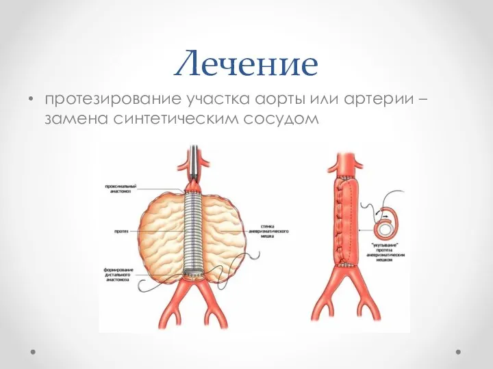 Лечение протезирование участка аорты или артерии – замена синтетическим сосудом