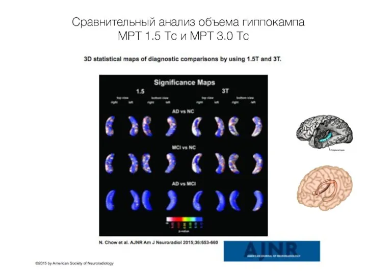 Сравнительный анализ объема гиппокампа МРТ 1.5 Тс и МРТ 3.0 Тс