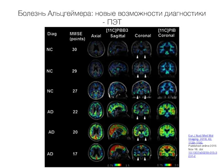 Болезнь Альцгеймера: новые возможности диагностики - ПЭТ Eur J Nucl Med Mol