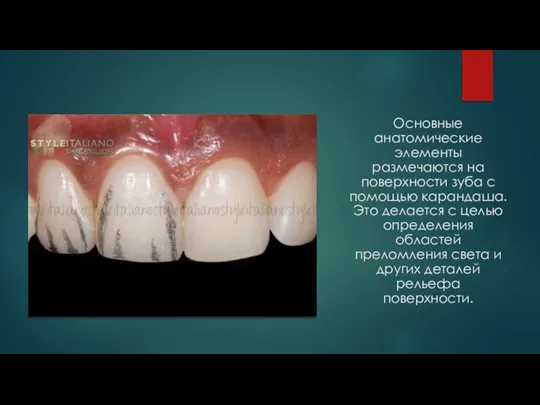 Основные анатомические элементы размечаются на поверхности зуба с помощью карандаша. Это делается
