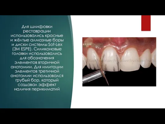 Для шлифовки реставрации использовались красные и жёлтые алмазные боры и диски системы