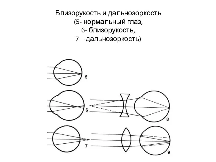 Близорукость и дальнозоркость (5- нормальный глаз, 6- близорукость, 7 – дальнозоркость)