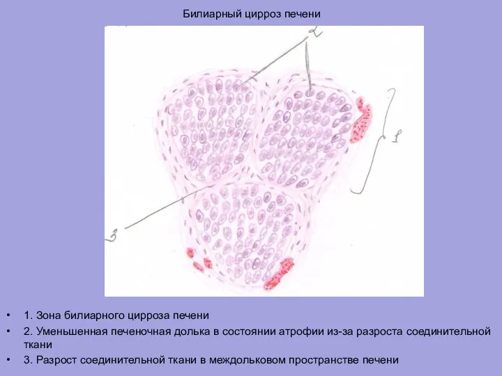 Билиарный цирроз печени 1. Зона билиарного цирроза печени 2. Уменьшенная печеночная долька