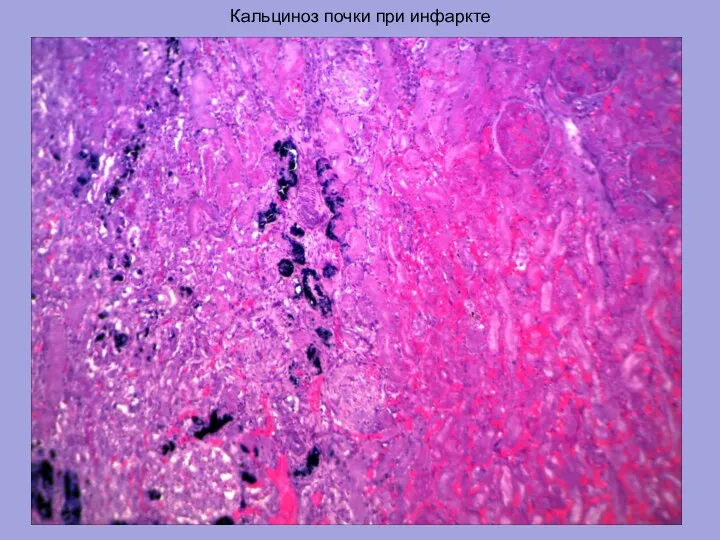 Кальциноз почки при инфаркте