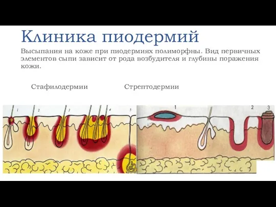 Клиника пиодермий Высыпания на коже при пиодермиях полиморфны. Вид первичных элементов сыпи