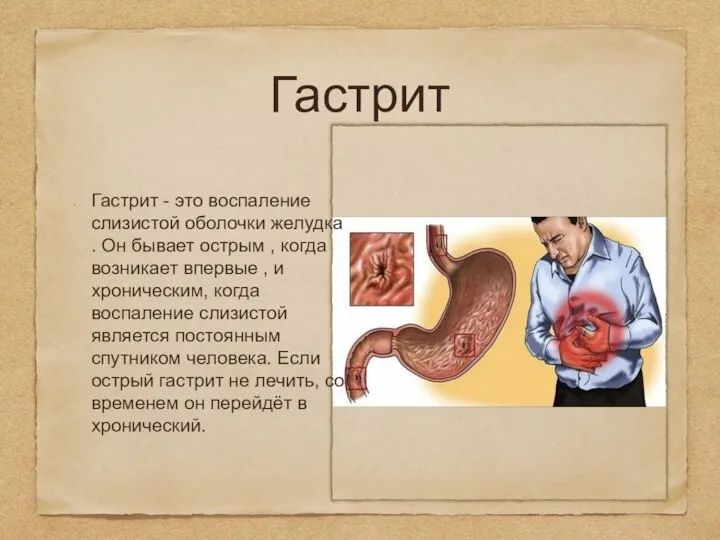 Гастрит Гастрит - это воспаление слизистой оболочки желудка . Он бывает острым